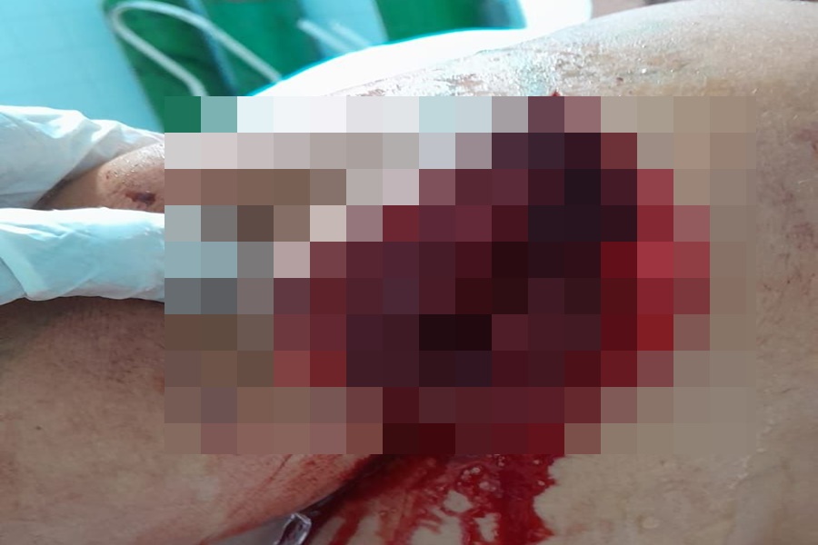 Imagem: Braco da vitima quase foi decepado Homem é detido após tentativa de homicídio e disparos contra esposa e amigo