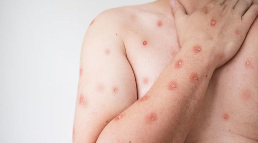 Imagem: CASO SES alerta para monitoramento de casos de Mpox em MT após avanço de variante em Rondônia Imagem: CASO SES alerta para monitoramento de casos de Mpox em MT após avanço de variante em Rondônia