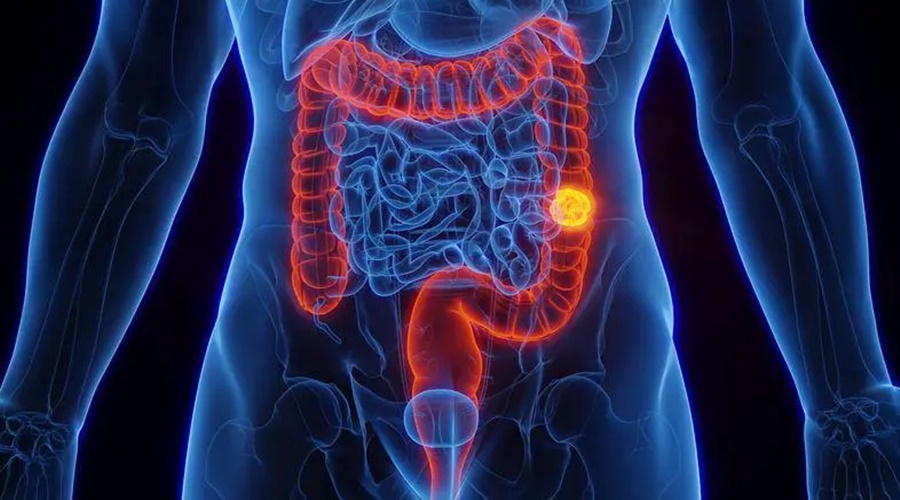 Imagem: CANCER DE INTESTINO Sistema Único de Saúde adota novo exame para rastrear câncer de intestino na população Imagem: CANCER DE INTESTINO Sistema Único de Saúde adota novo exame para rastrear câncer de intestino na população
