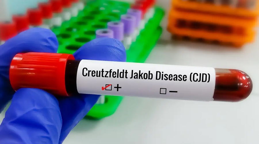 Imagem: Doenca de Creutzfeldt Jakob Entenda o que é a doença de Creutzfeldt-Jakob e como ocorre a busca por tratamento