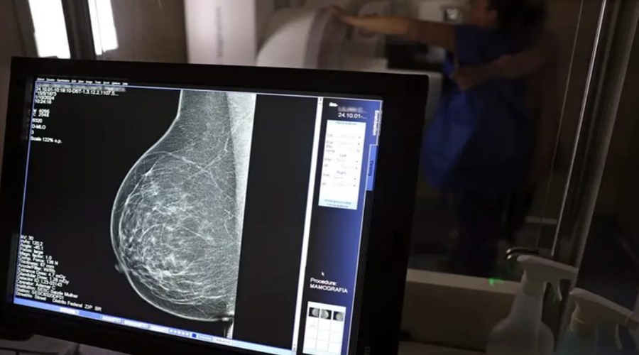 Imagem: mamografia INCA alerta para diagnóstico tardio e maior agressividade do câncer de mama em mulheres negras